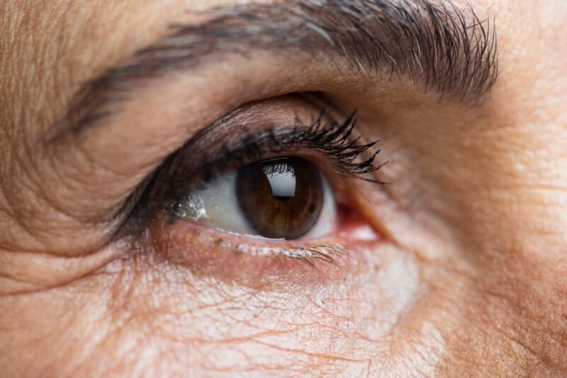 blefaroplastia a laser