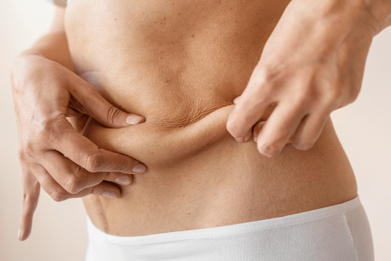flacidez abdominal