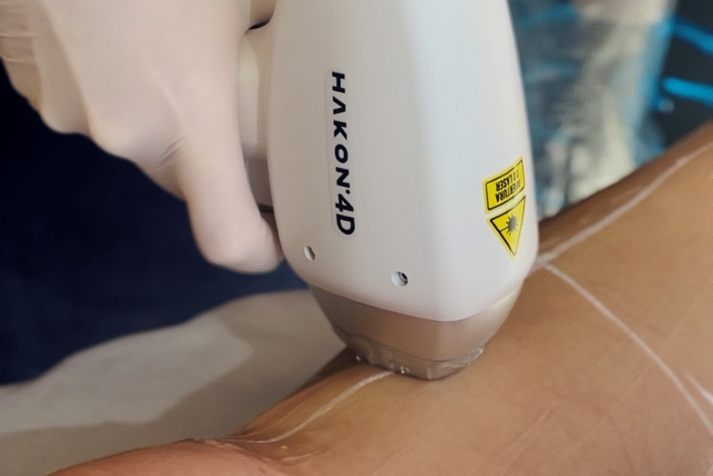 Depilação a Laser em 4D com Hakon: Tecnologia, Conforto e Resultados